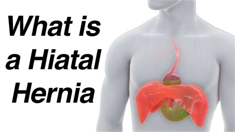 What Is A Hiatal Hernia Animation And How It Causes Reflux Youtube
