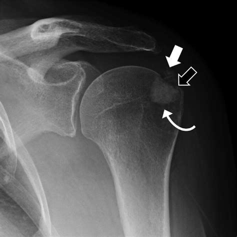 A 66 Year Old Female Presents With Acute On Chronic Left Shoulder Pain