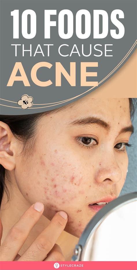 Top 10 Foods That Can Cause Acne And What To Eat For Clear Skin Acne