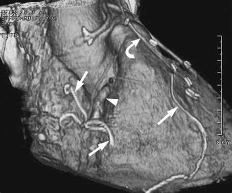 During angiography, a special dye called a 'contrast medium' is. Pitfalls, Artifacts, and Remedies in Multi- Detector Row ...