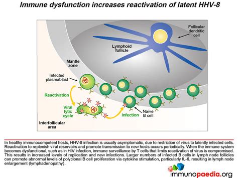 Multicentric Castlemans Disease Mcd Immunopaedia