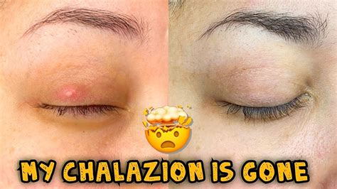Update My Chalazion Is Gone How Did I Get Rid Of It YouTube
