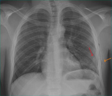 29 Yo Male Has Left Sided Chest Pain Which Started After Falling Off A