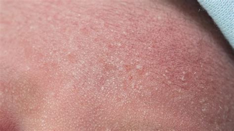 What Causes Tiny Itchy Bumps On Face