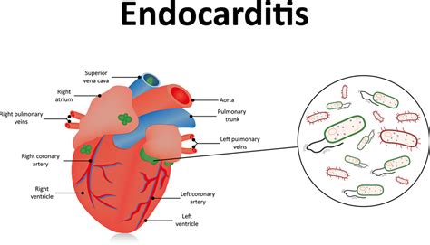 What Is Endocarditis Symptoms And Causes Dr Raghu