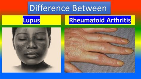 Contrast Between Lupus And Rheumatoid Arthritis Youtube