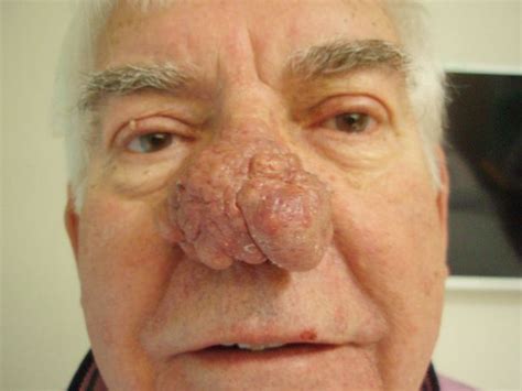 Shocking Before Pictures Show How Rare Condition Made Mans Nose Grow