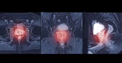 Prostate Cancer Screening Using Mri After Psa Test A Cost Effective