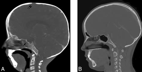 Craniofacial Abnormalities In Hutchinson Gilford Progeria Syndrome