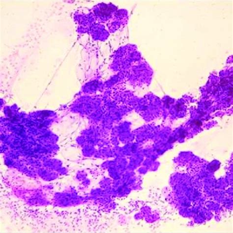 Cytomorphology Of Sialadenosis Showing Benign Salivary Acini With Few