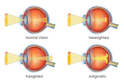 What Does Nearsightedness Mean Frequently Answered Eye Care Website