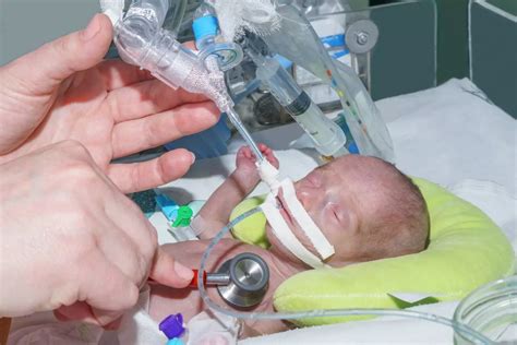 Understanding Meconium Aspiration Syndrome In Babies