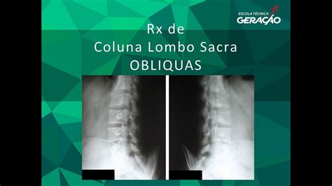 Radiografia Da Coluna Lombo Sacra Obliquas YouTube