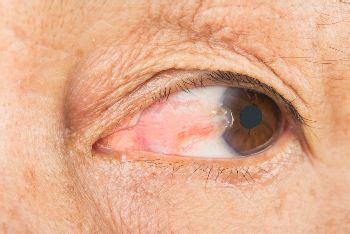 Mancha amarilla en el ojo abultada Qué es causas y tratamiento