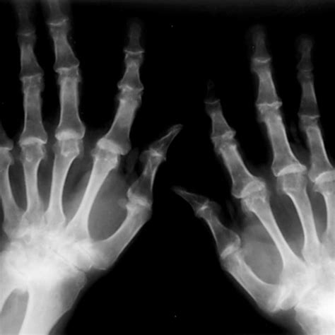 Radiographs Of The Wrists And Hands Osteoarthritis Of The Distal