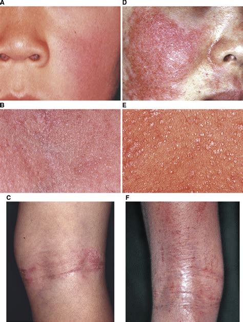 Examples Of Mild Rashes And Rashes With Severe Inflammation Of Atopic