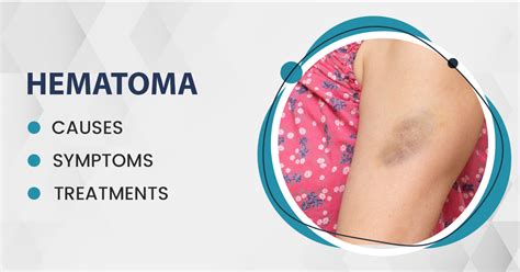Hematoma Causes Symptoms And Treatments Gpsh