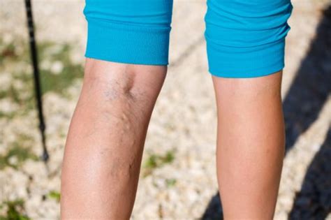 What You Need To Know About Varicose Veins Health Enews