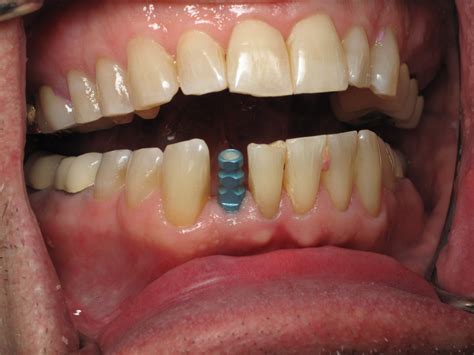 Do not bite food with incisor teeth (front teeth), but with teeth a bit more to the sides, around the canines and kisorlok, and use both sides of the denture at the same time while chewing! Lower Front Tooth Dental Implant -Immediate Tooth ...