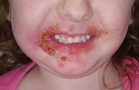 What Does It Mean To Have A Rash On Your Lips