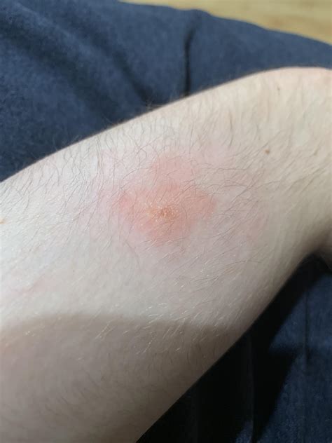 What Is This A Red Itchy Bump Appeared On My Arm Yesterday Today