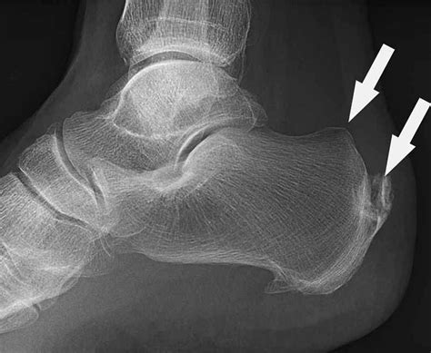 Is Your Heel Pain Caused By Haglunds Deformity Tma
