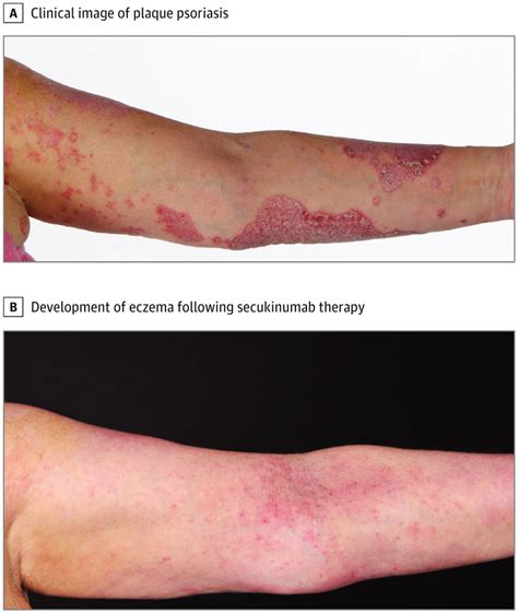 Morphologic Switch From Psoriasiform To Eczematous Dermatitis After