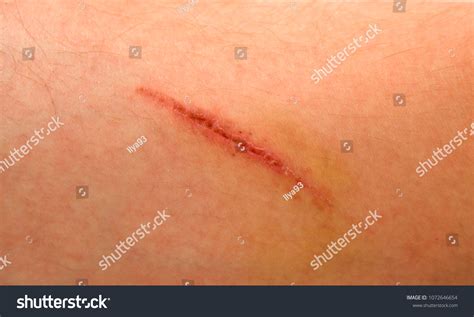 Wound On Human Body Suture Old Stock Photo Edit Now 1072646654