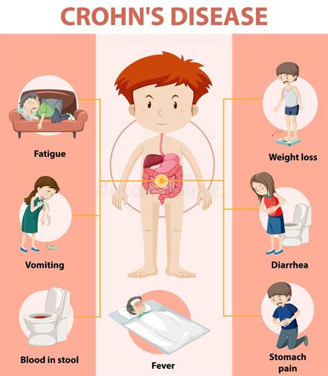Medical Infographic Of Crohn S Disease Stock Vector Illustration Of Diarrhea Blood