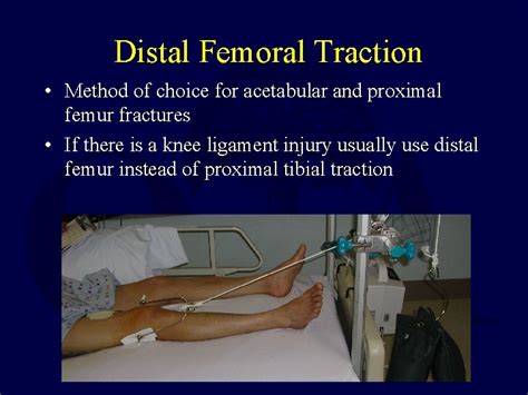 Bucks Traction For Femur Fracture Traction In Orthopaedics It Can