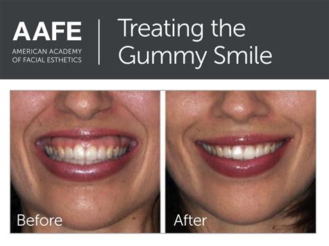 Gummy Smiles Are Successfully Treated With Botox When Performed By