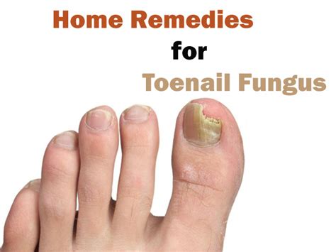 How To Get Rid Of Toe Nail Fungus Best Home Remedies For Toenail