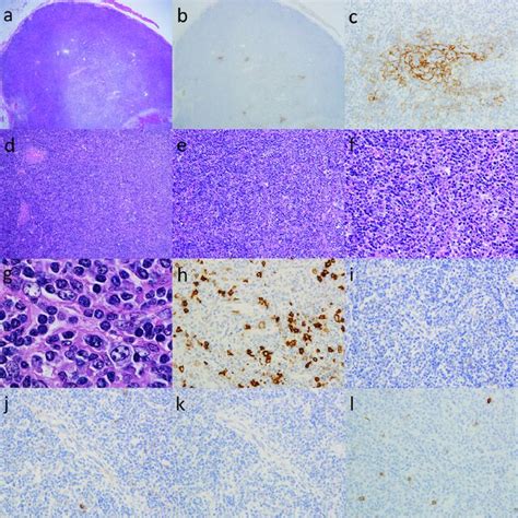 Atypical Paracortical Hyperplasia With Lymphoid Follicles Aphlf A