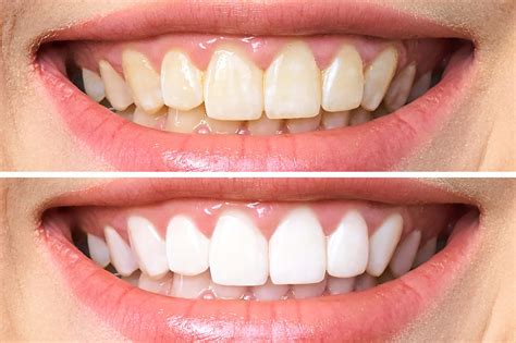 Safe Tips For Hydrogen Peroxide Teeth Whitening 2022