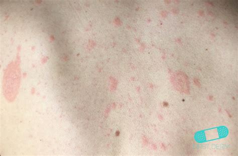 Pityriasis Rosea Viral Pictures Photos