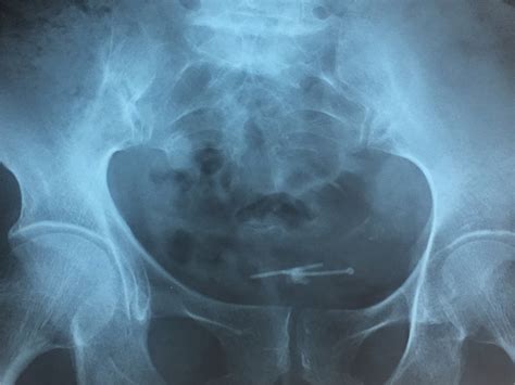 Plain Abdominal Radiograph Showing A 15 Mm Stone In The Pelvis