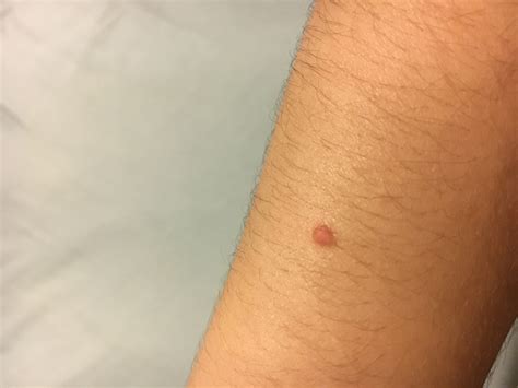 red bumps on upper arms