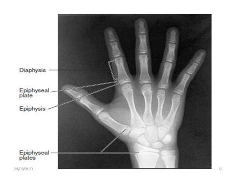 The Use Of Hand And Wrist Radiograph Opg And Cephalometric Radiograp