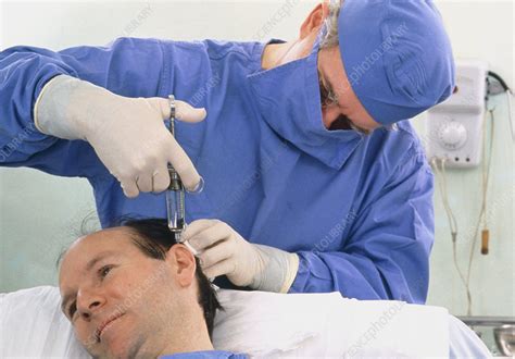 Local Anaesthetic For Baldness Reduction Surgery Stock Image M590
