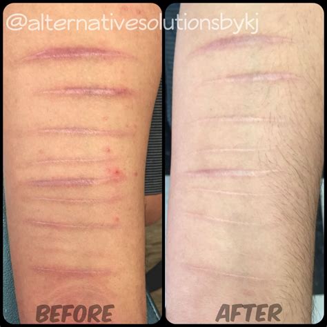 Skin Needling Scar Removal Before And After By Krystin Jones Tattoo