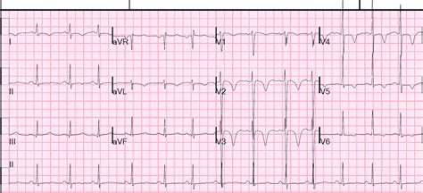 Dr Smiths Ecg Blog Wellens Waves Are Not Equivalent To Wellens