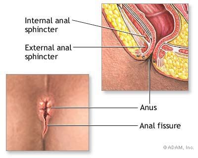 The New York Times Health Slide Show Anal Fissure Slide 2 Of 5