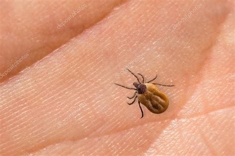 Tick Filled With Blood Crawling On Human Body Skin — Stock Photo