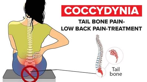 Coccydynia Tail Bone Pain Low Back Pain Treatment Explained By