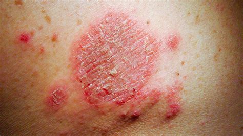 Red Skin Rash Hot Sex Picture