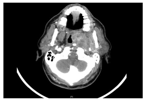 Ct Scan Showing Left Parapharyngeal Soft Tissue Mass Protruding Into