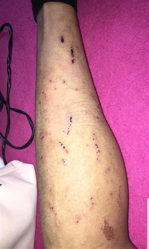 Womans Cancer Mistaken For Scabies After Leg Rash Tormented Her For