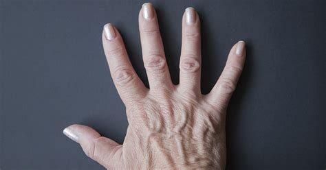 Psoriatic Arthritis Caring For Your Hands And Feet