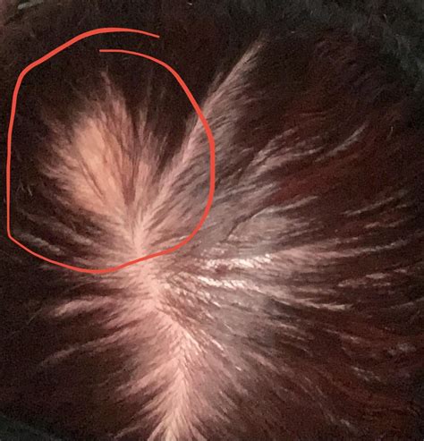 Random Bald Spot How To Fix 16 Rnaturalhair