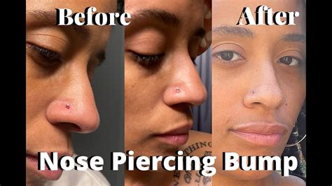 How To Get Rid Of A Nose Piercing Bump My Journey Youtube